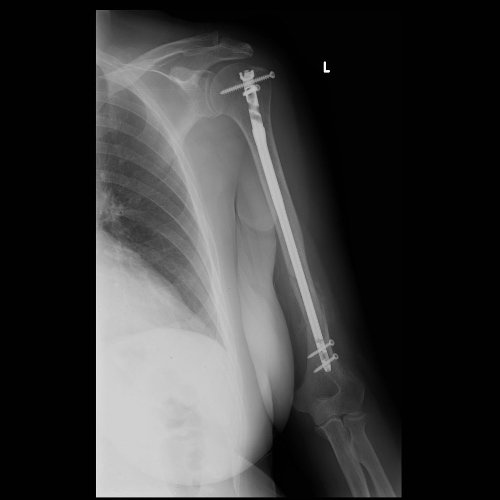 Poliklinika Arthros Odstranjenje metalnih implantata